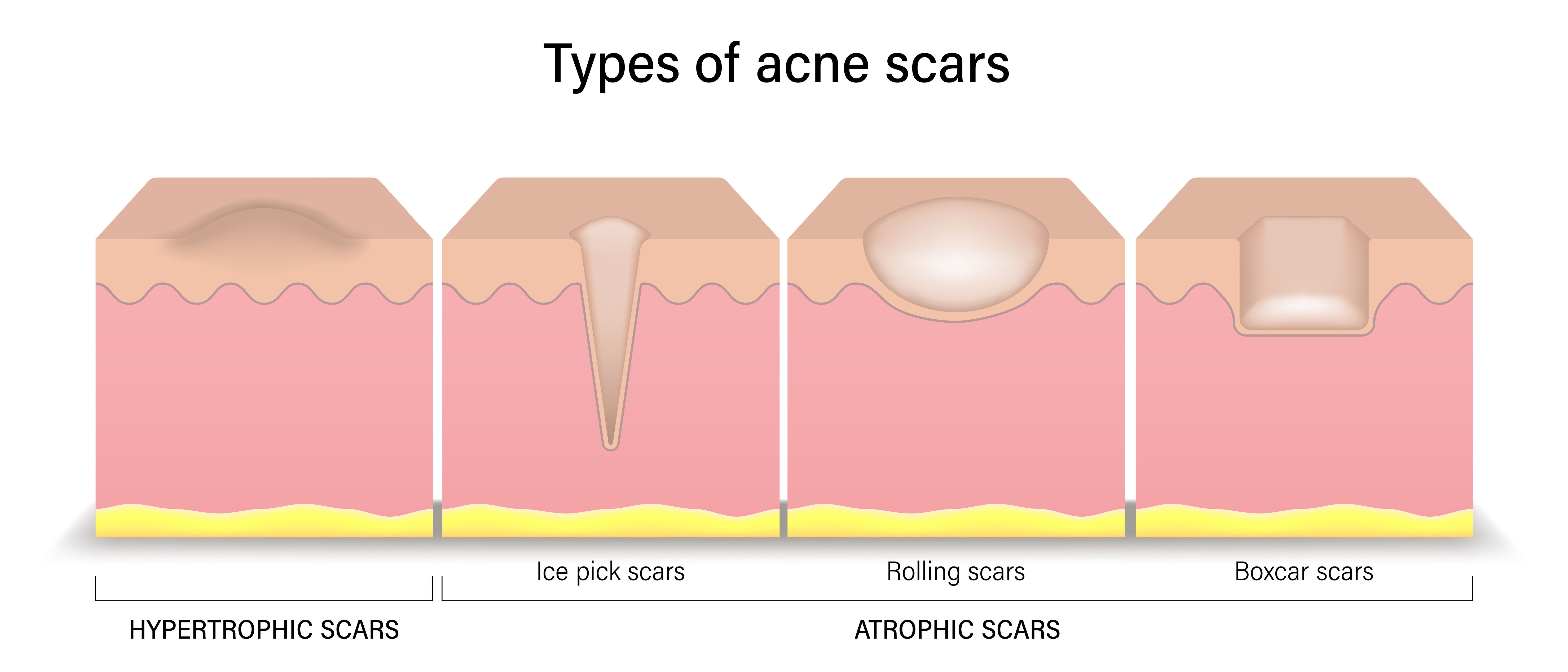 Considerations to Manage Different Types of Acne Scars