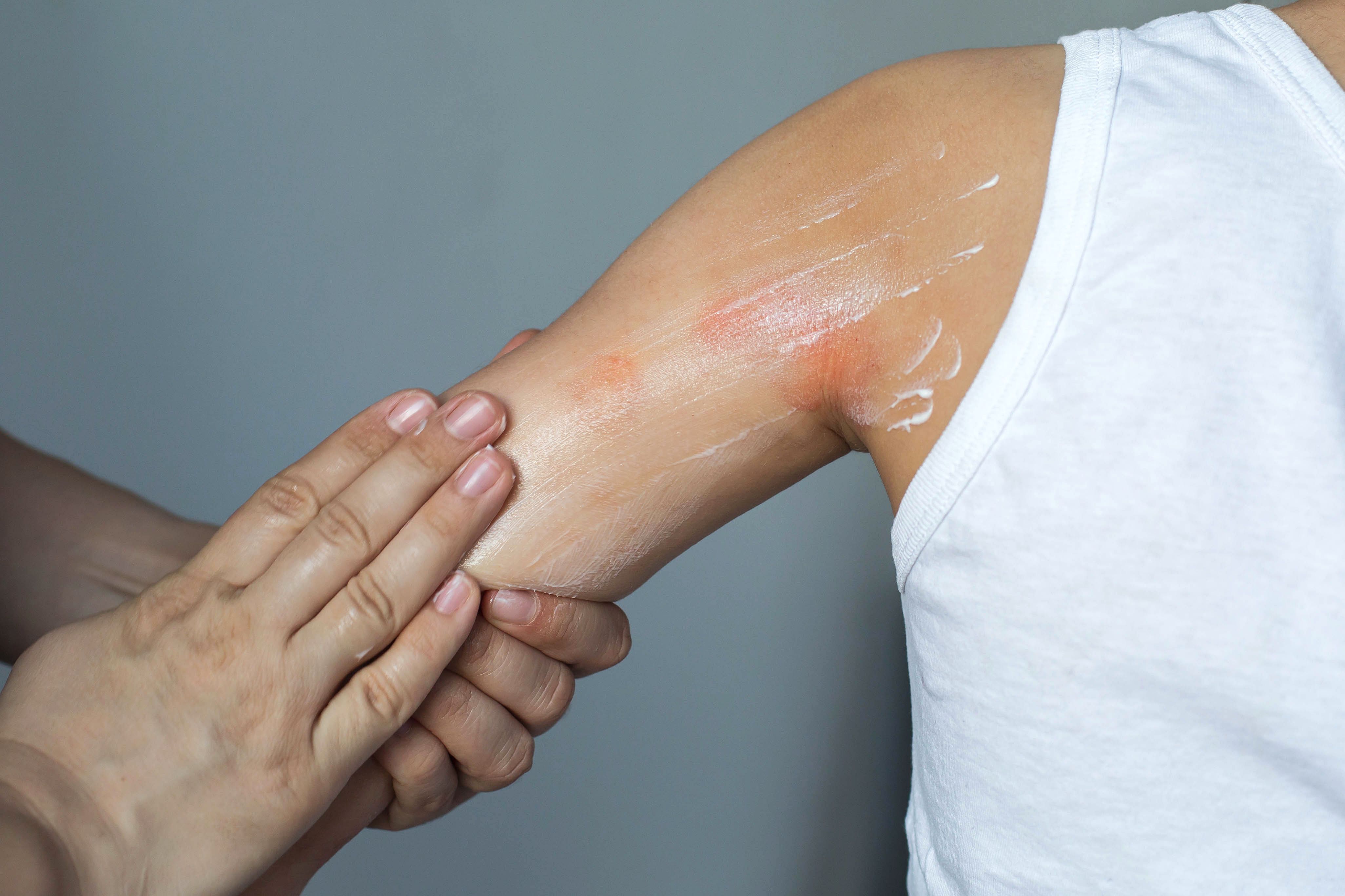 The Burden of the Atopic March: Real-World Data on Pediatric AD and Allergic Comorbidities in Japan