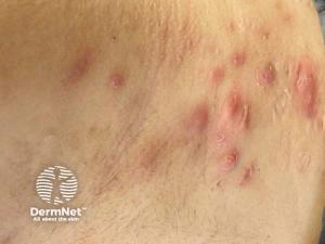 Filling the HS Treatment Gap: Ruxolitinib Targets Early-Stage Disease