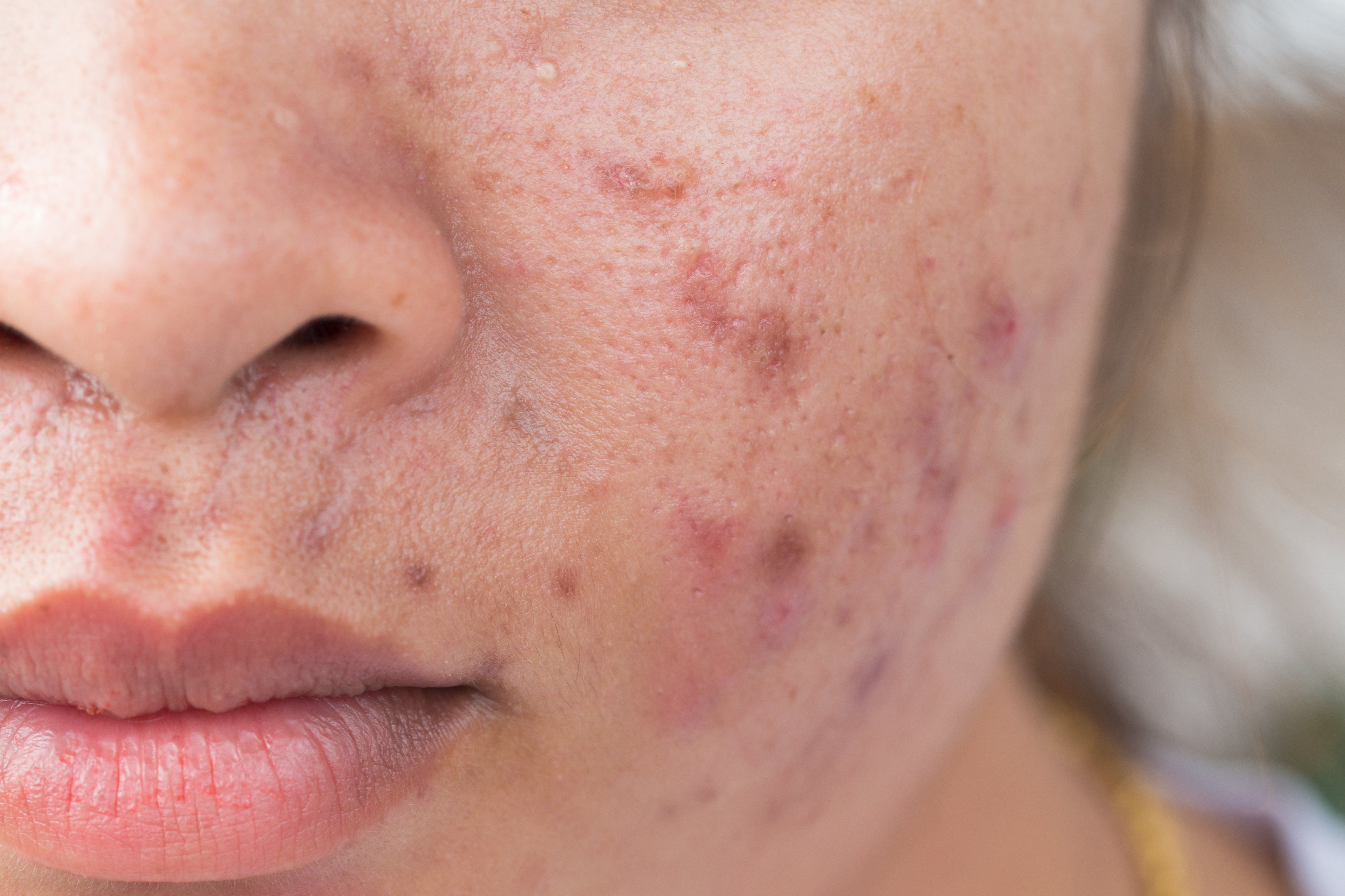 Treatment options for acne expand.