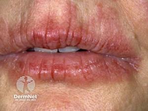 Study Finds Psoriasis Patients Trust Topical Therapies Less Than Those With AD