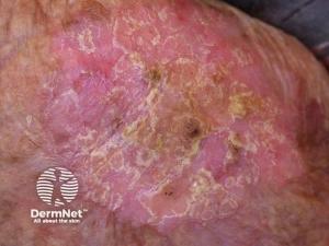 Bowen’s Disease on Lower Extremities: A Rare Case Report