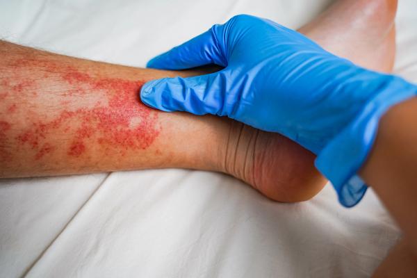 Rezpegaldesleukin Improves Atopic Dermatitis in Phase 2b Trial