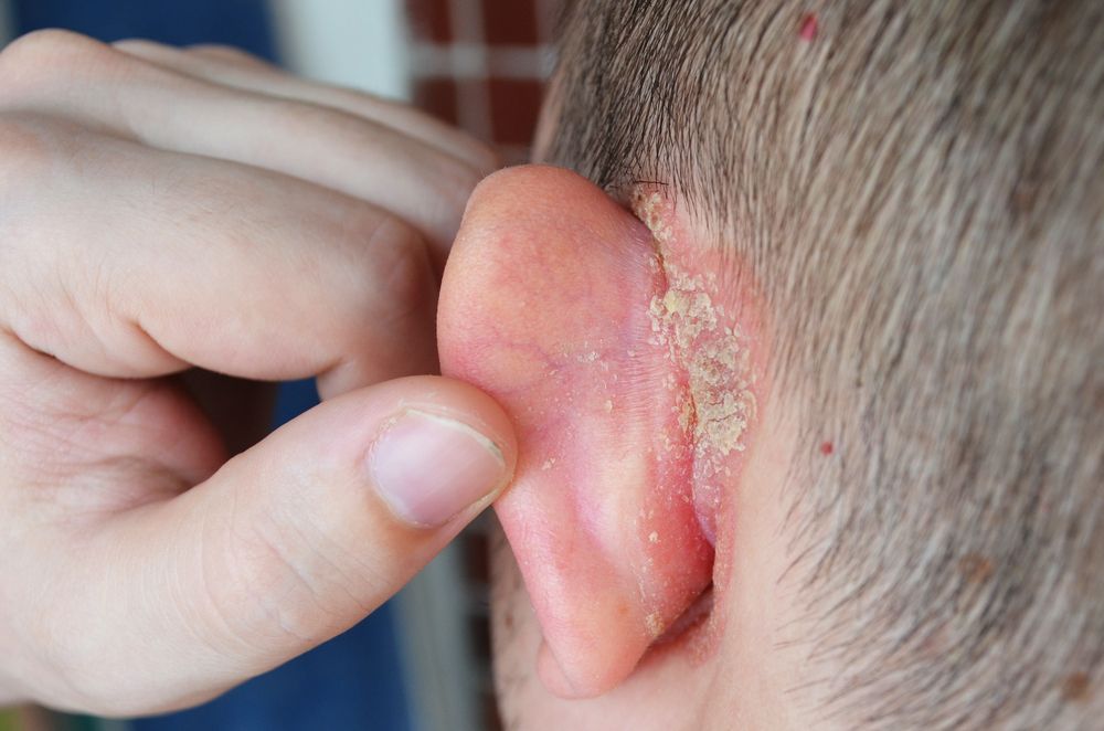 psoriasis behind ear treatment)