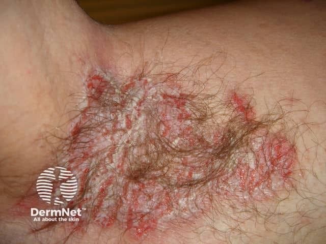 <![CDATA[New Research Evaluates Ablative CO₂ Laser Therapy for Refractory Hailey–Hailey Disease]]>