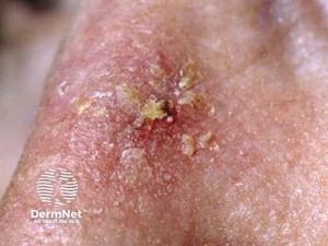 Biofrontera Completes Enrollment and Active Treatment Phase in Phase 3 Ameluz PDT Trial for AK on the Body
