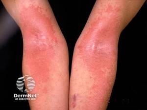 BBT001 Bispecific Antibody Demonstrates Fast AD Clearance and Long-Lasting Itch Relief in Phase 1 Trial