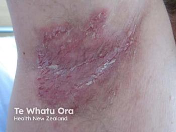 Image Credit: © DermNet