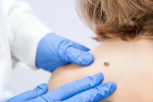 Increasing Rates of Melanoma and What to Look For