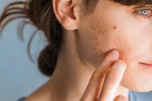 Isotretinoin for Adolescent Acne Shows No Cognitive Impairment Despite Rise in Internalizing Symptoms
