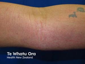 Atopic dermatitis 