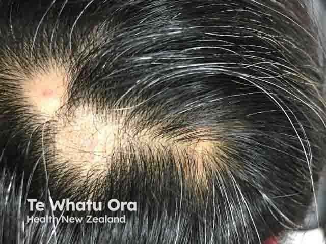 What Works for Patients with Alopecia Areata