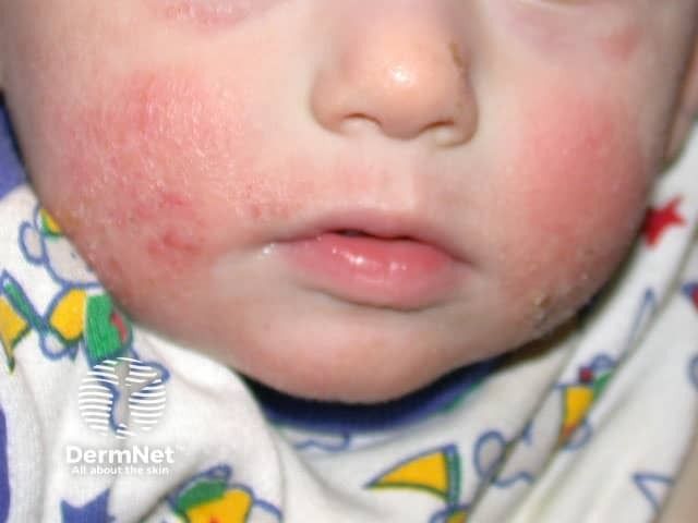 New Trial Explores AD Treatment in Patients Under 2