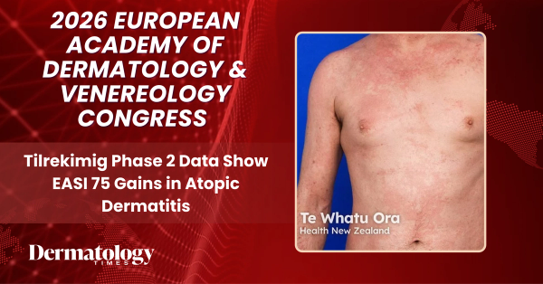 Tilrekimig Phase 2 Data Show EASI 75 Gains in Atopic Dermatitis