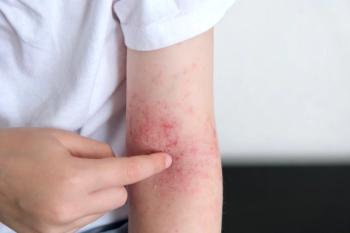Q&A: 3-Year Nemolizumab Data Reinforce Long-Term Disease Control in Atopic Dermatitis