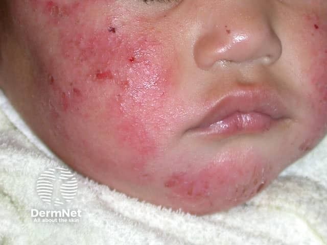 Dupilumab Associated With Lower Atopic March Risk in Pediatric Atopic Dermatitis