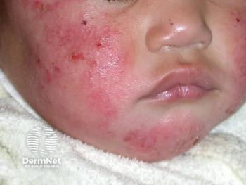 Pediatric atopic dermatitis