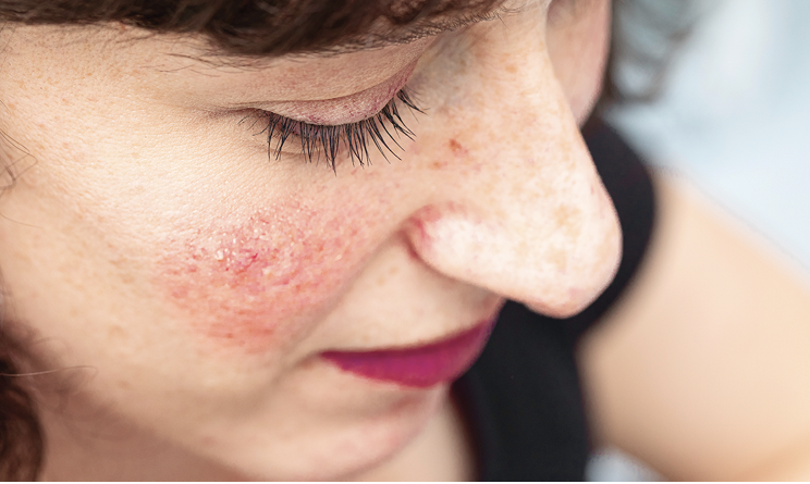 Emrosi Skin Rash DFD-29: The Journey to FDA Approval and a New Era in Rosacea Management