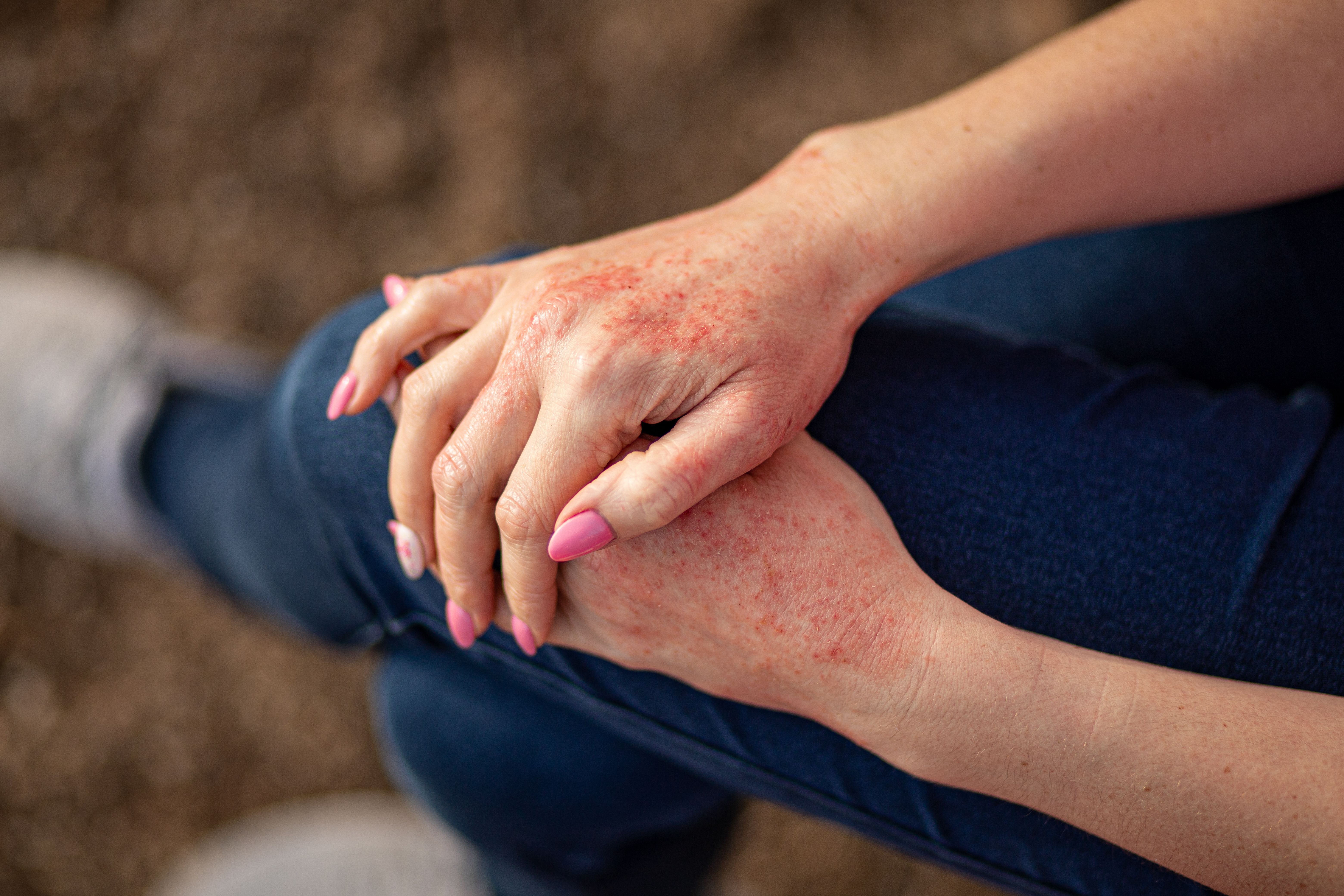 Rocatinlimab Maintains Safety Profile in 24-Week AD Study