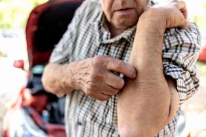 Wildfire Air Pollution Drives Surge in Clinic Visits for AD and Pruritus