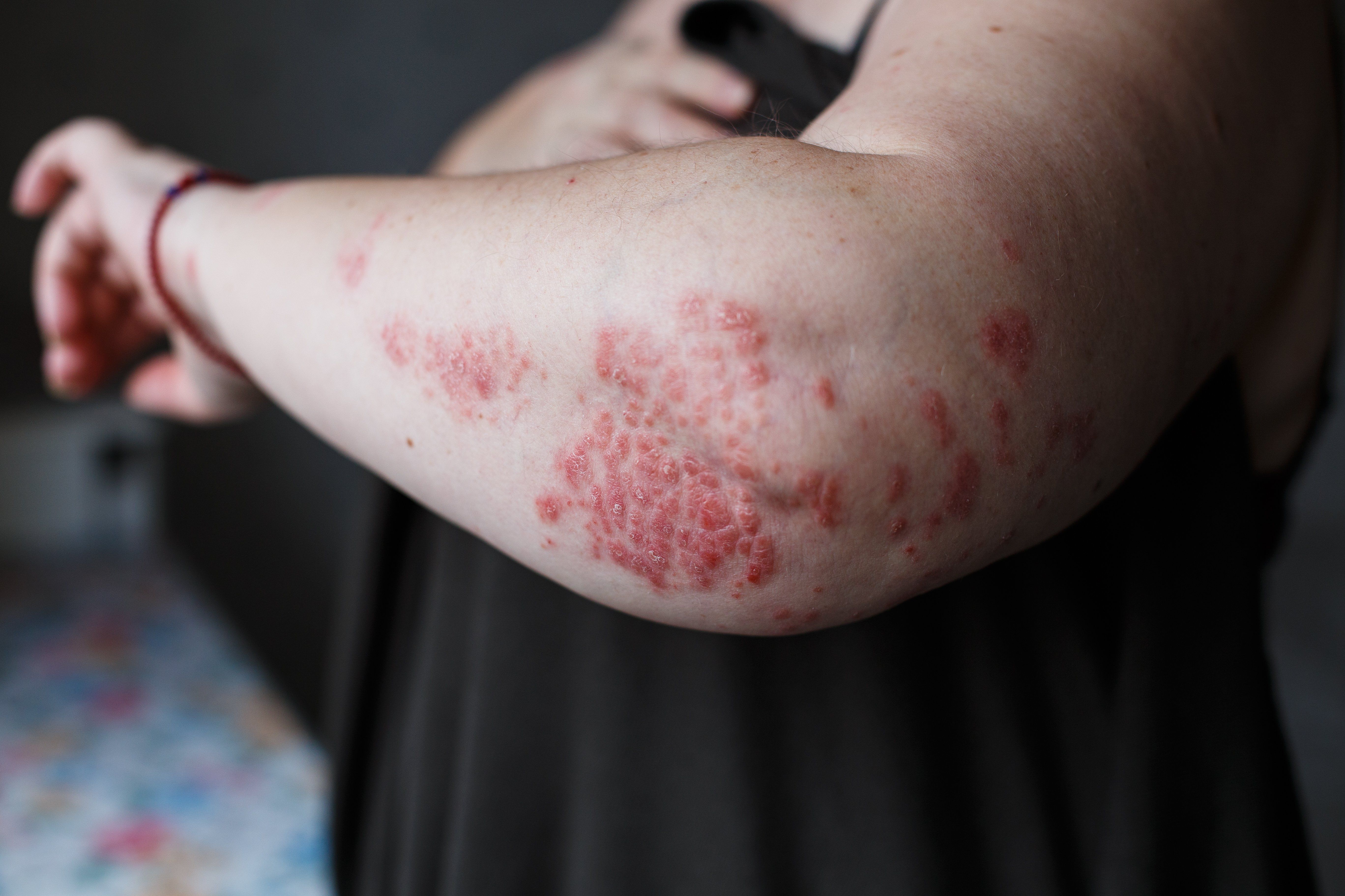 red psoriasis plaques on elbow