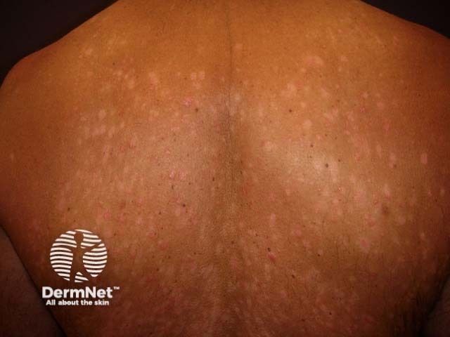 bpc-157 psoriasis evidence Biologics in Prevention of Psoriasis