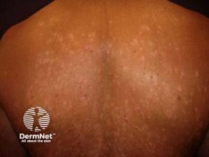 Why Do Some Psoriasis Patients Respond Differently to Biologics? New Study Offers Clues