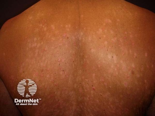 Why Do Some Psoriasis Patients Respond Differently to Biologics? New Study Offers Clues