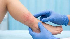 AAD Pediatric AD Guidelines Back Roflumilast, Ruxolitinib, Tapinarof