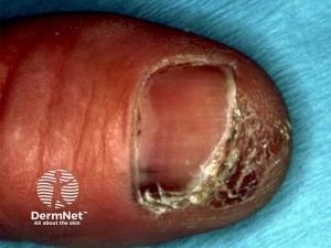 Nail Pathology in Clinical Practice with Phoebe Rich, MD