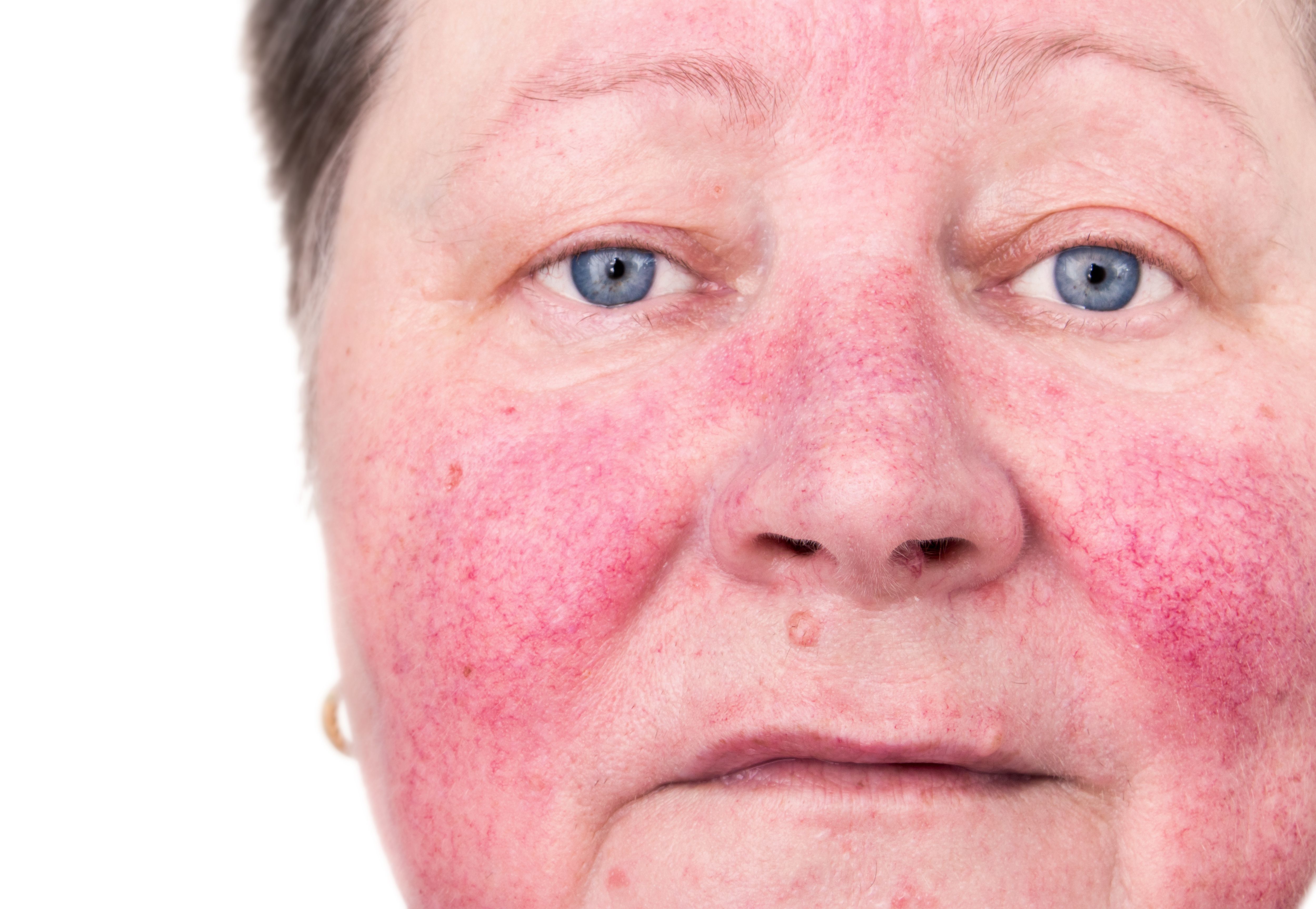 rosacea, flushing face