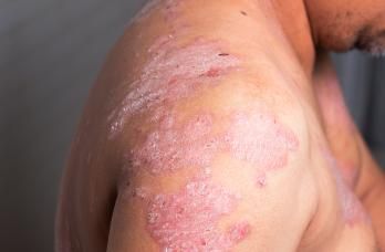 new psoriasis treatment 2021 injection