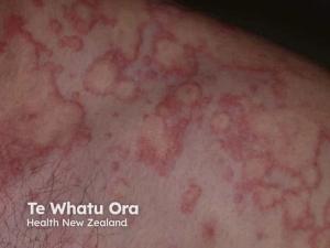 Chronic Urticaria Perceptions Vary Among Clinicians, Study Finds