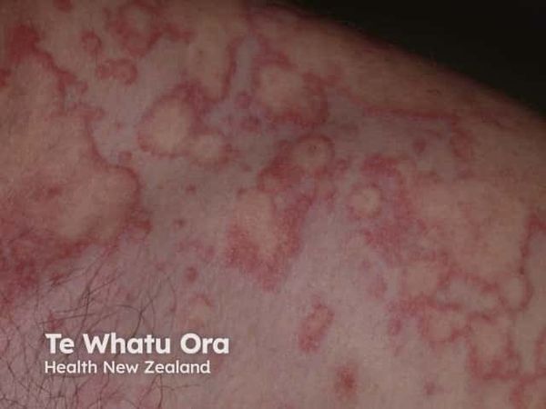 Barzolvolimab Achieves All Phase 3 End Points in Chronic Spontaneous Urticaria