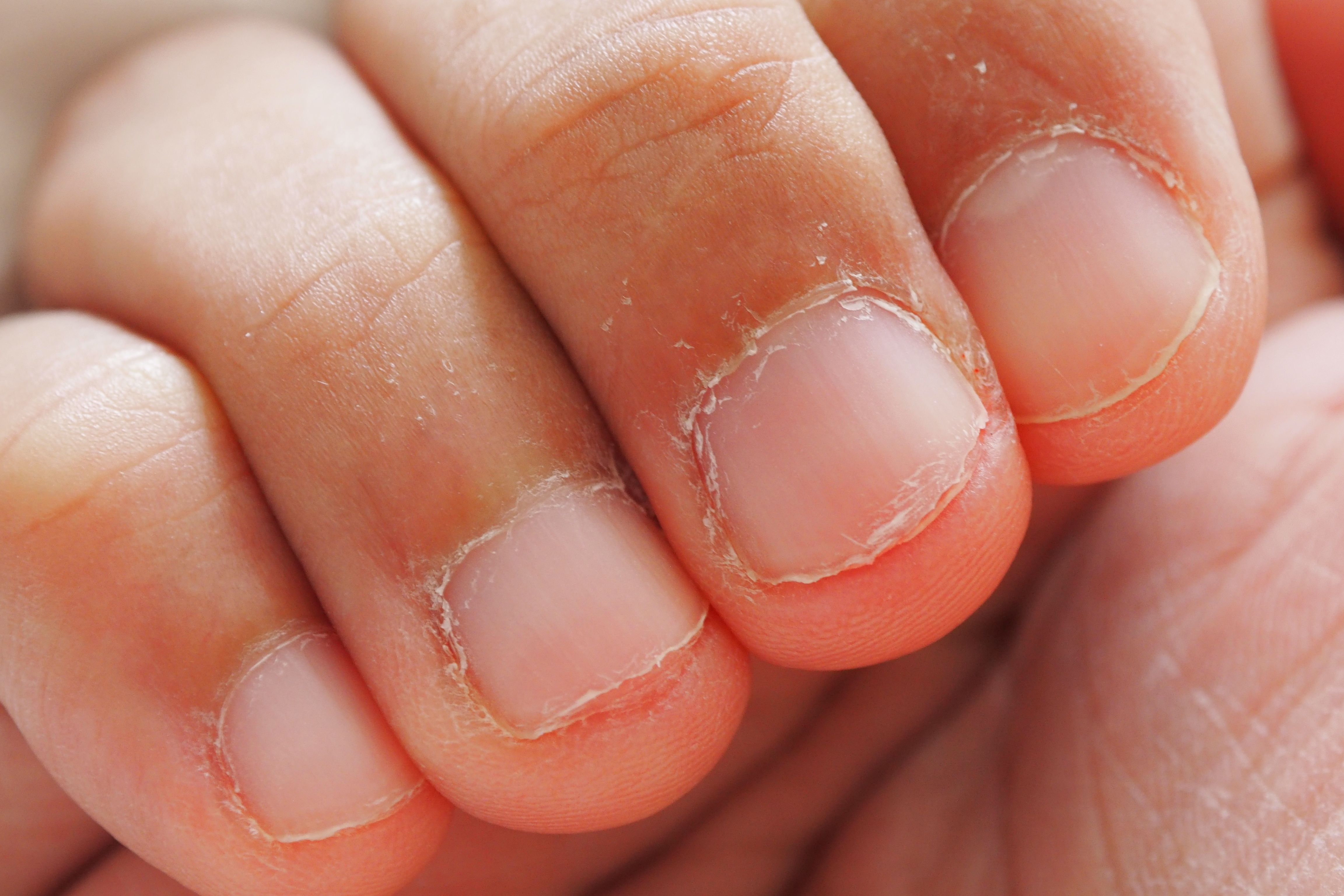 Anatomical Characteristics and Surgical Treatments of Pincer Nail Deformity