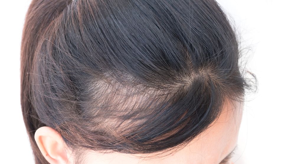 frontal alopecia