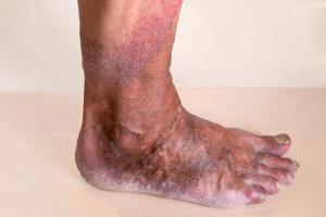 Remote Assessments Show Crisaborole Ointment Eases Stasis Dermatitis