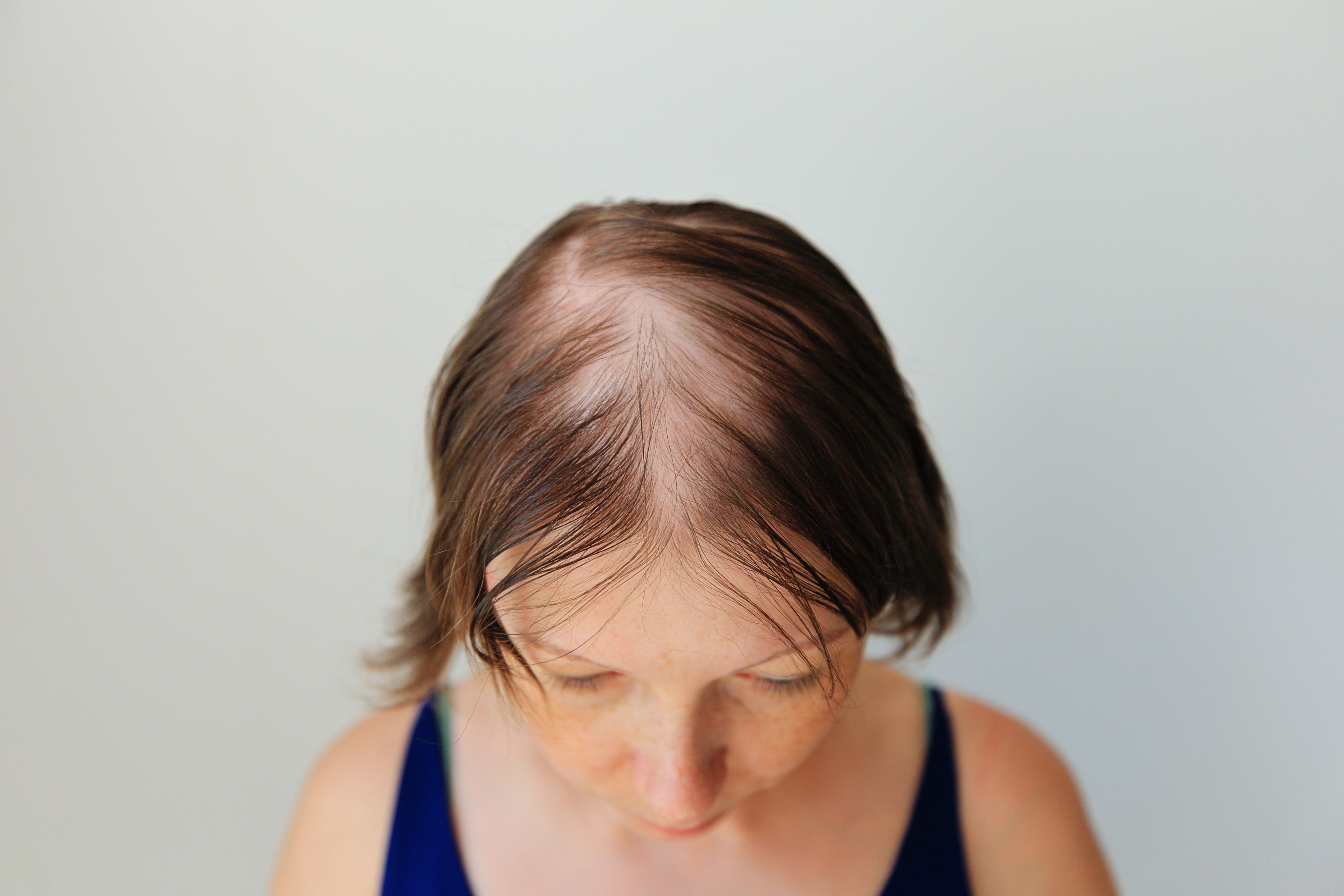 Alopecia Areata Hairstyles Uptitration of Baricitinib Effective in Improving Hair Growth in