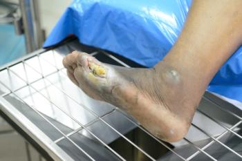 diabetic foot ulcer wound