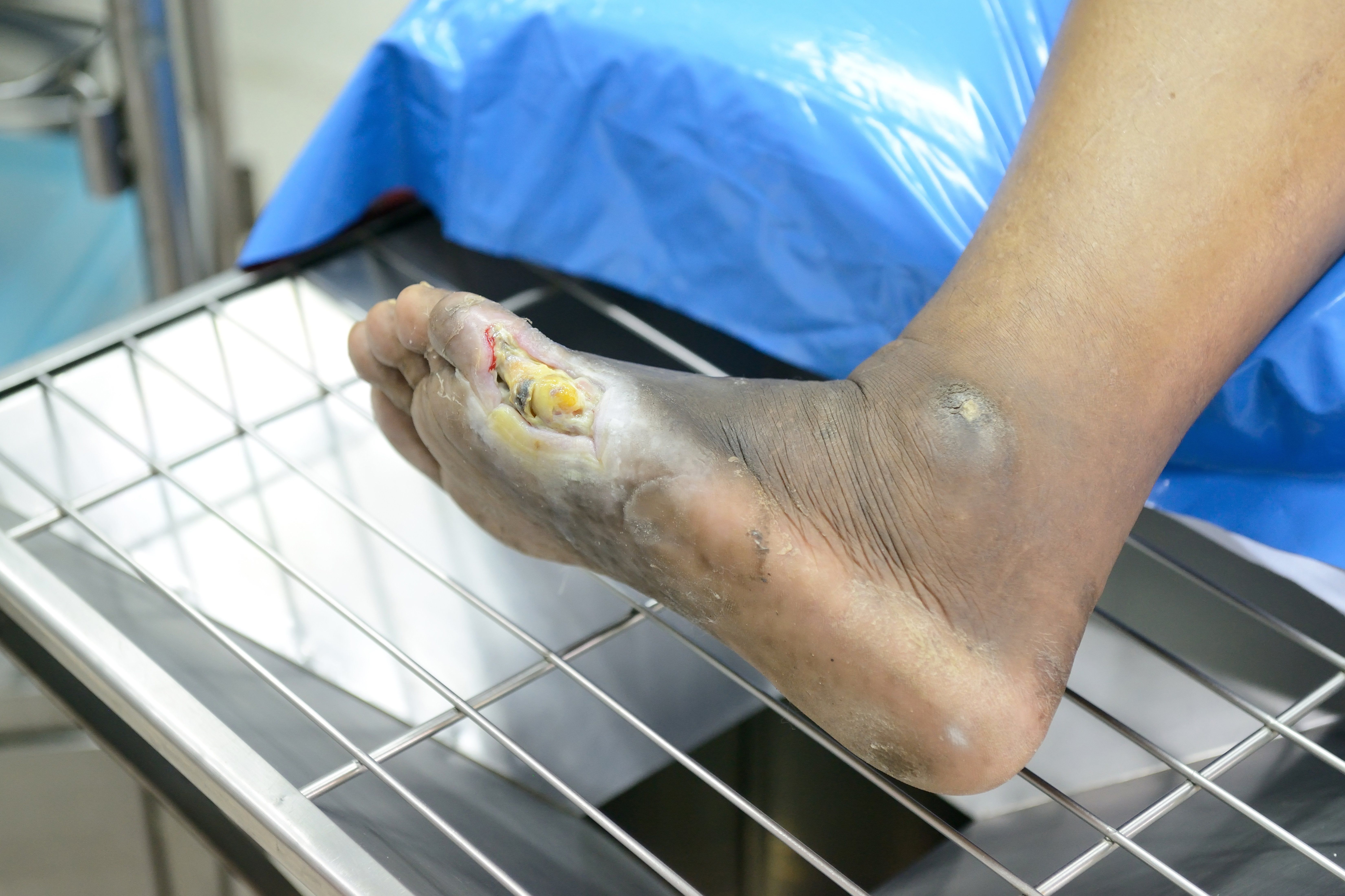 diabetic foot ulcer wound