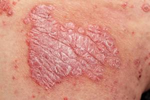 Ixekizumab Plus Tirzepatide Shifts Biomarkers in Psoriasis with Obesity