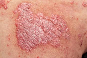 Ixekizumab Plus Tirzepatide Shifts Biomarkers in Psoriasis with Obesity