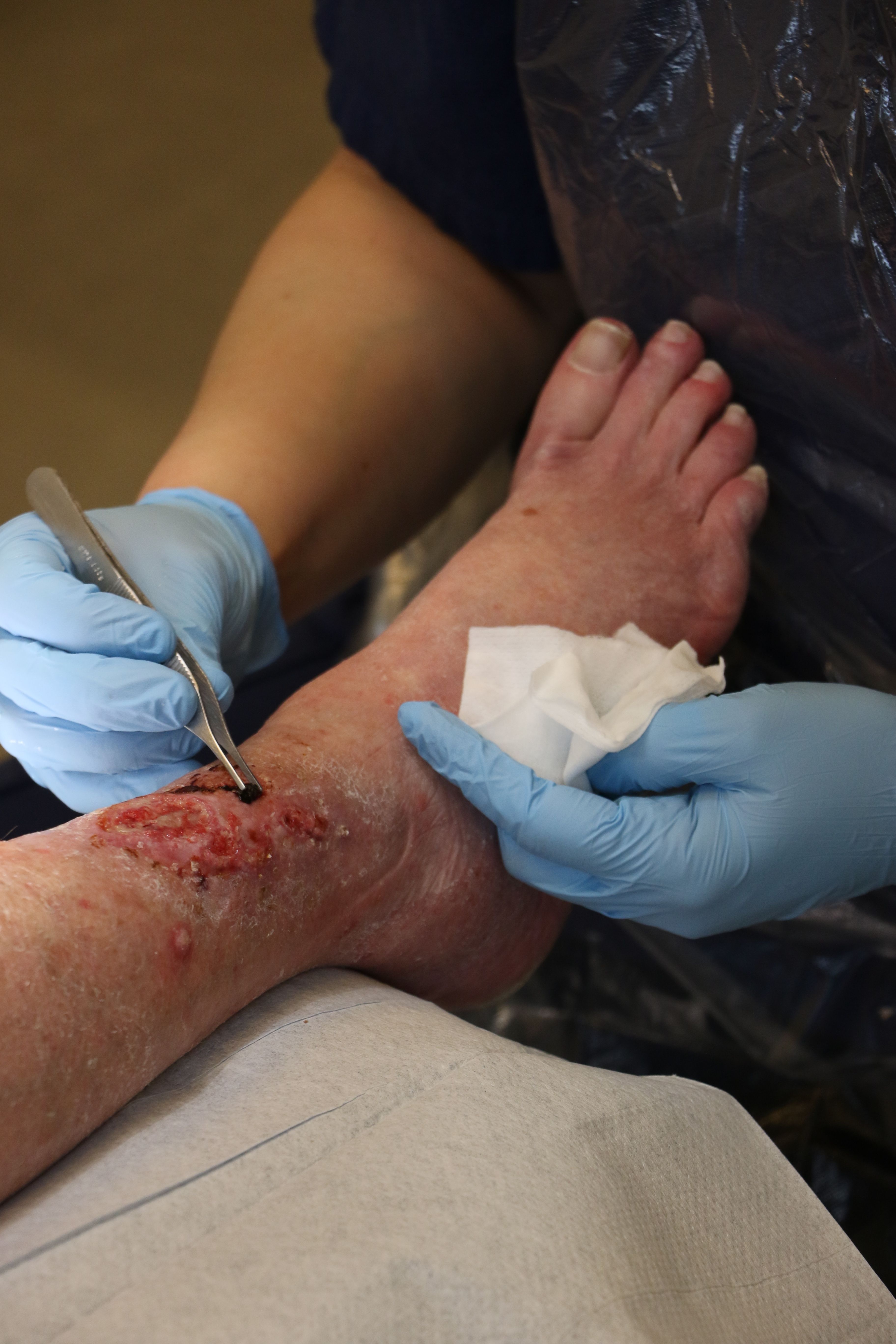 leg wound ulcer
