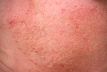papulopustular rosacea
