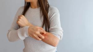 Select Skin Diseases are Higher in Patients with Inflammatory Bowel Disease