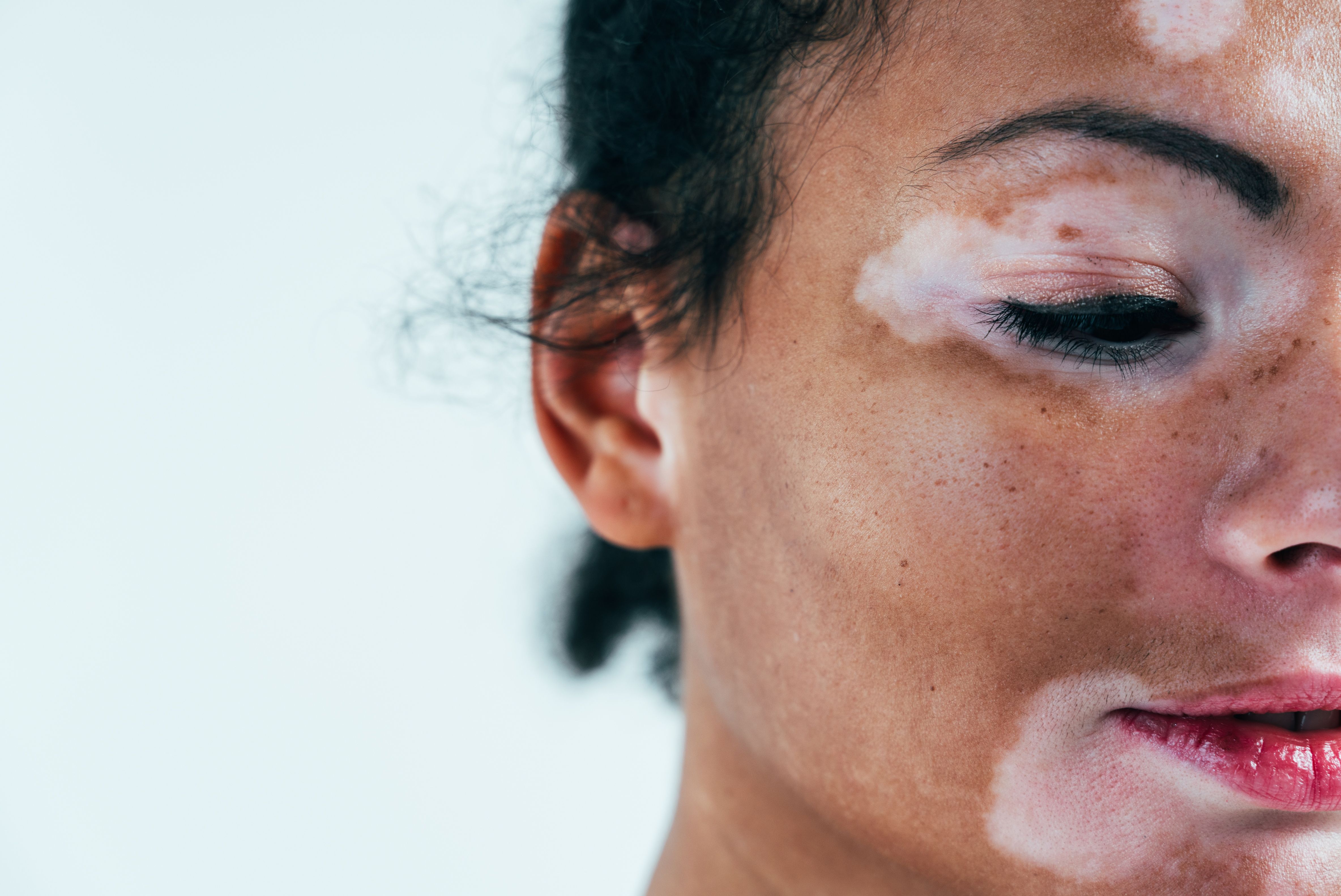 Upadacitinib Plus Excimer Laser Efficacious in Treating Refractory Vitiligo With Moderate to Severe Atopic Dermatitis