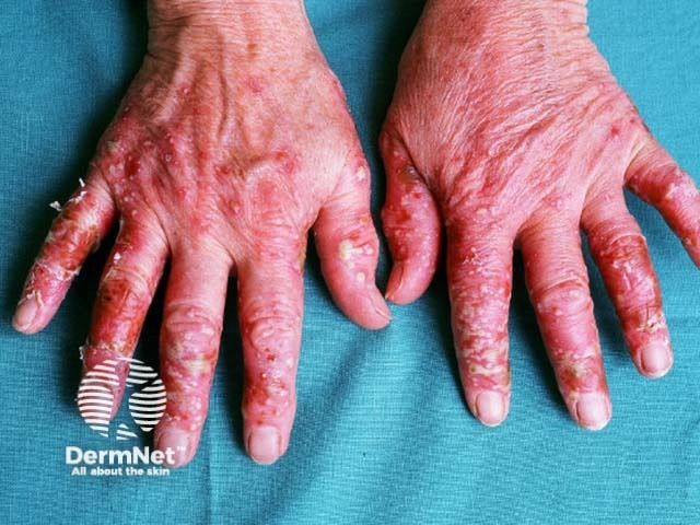 52-Week Study Reveals Efficacy and Safety of Apremilast for Japanese Patients with Palmoplantar Pustulosis