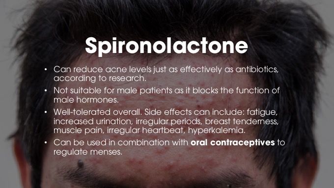 Spironolactone for acne