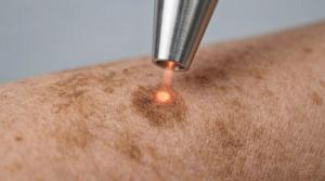 FDA Approves Ameluz Red Light PDT for Superficial Basal Cell Carcinoma