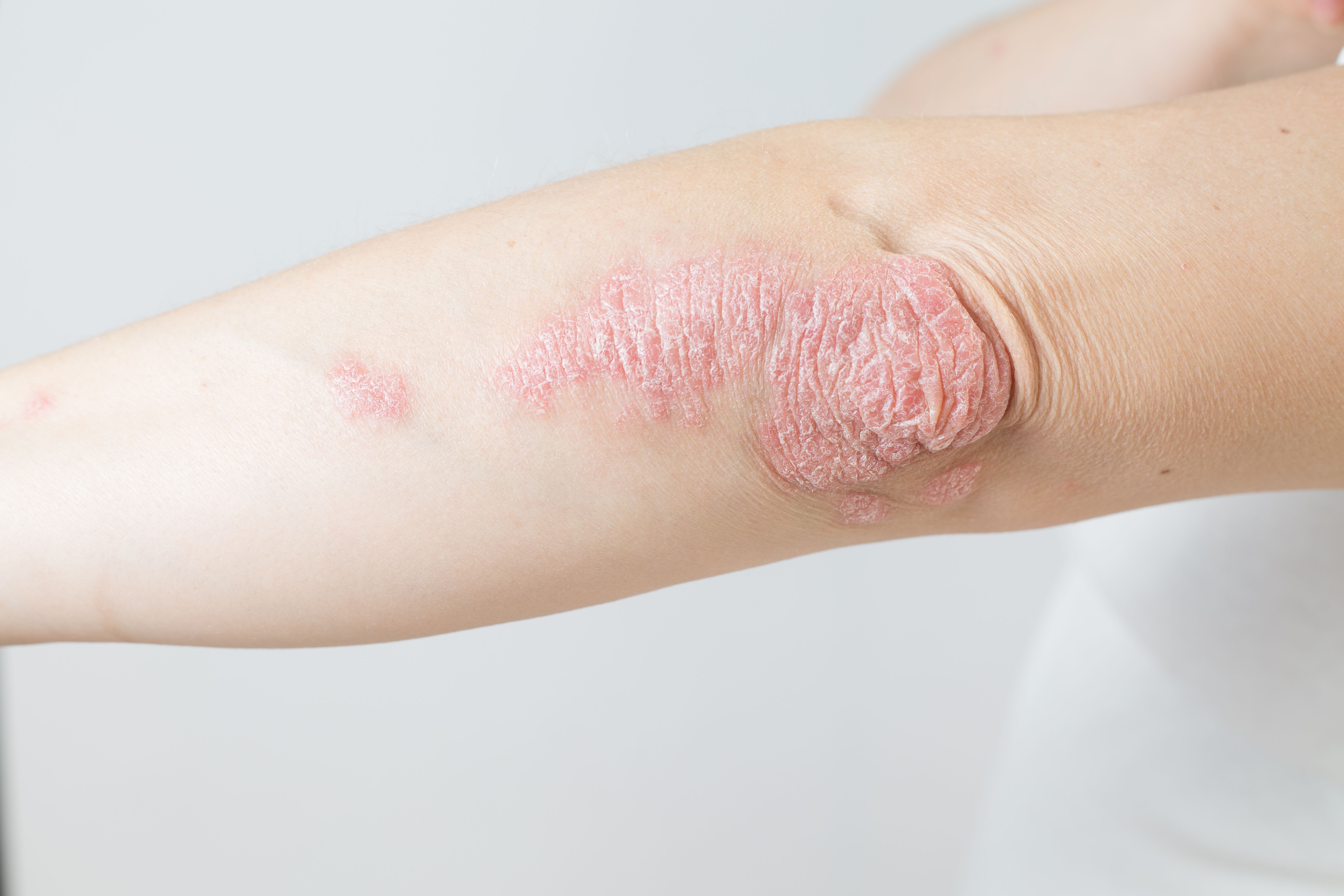 Psoriasis 